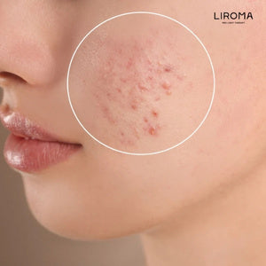 Gezichtsmasker tegen acne